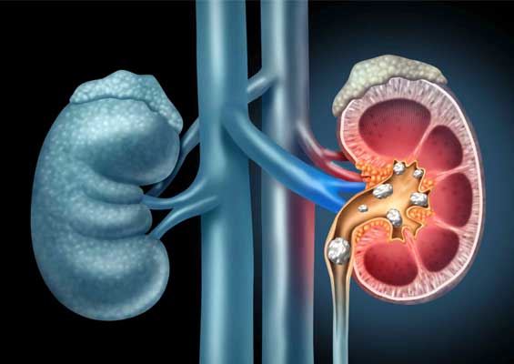 Chronic-kidney-disease