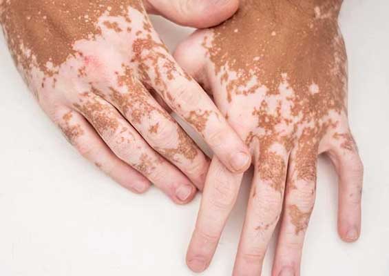 Vitiligo